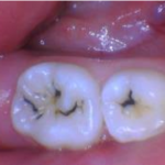 Primary molars treated with SDF